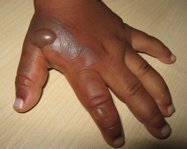 Les différentes brûlures, photo d'une main avec une brûlure de second degré